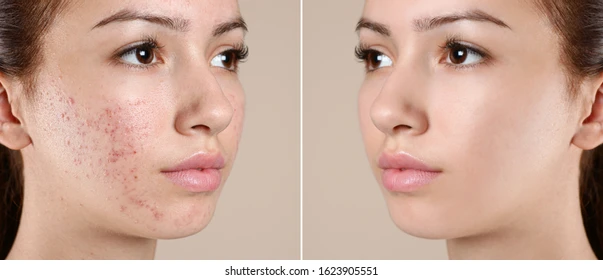 Acne Treatment Result